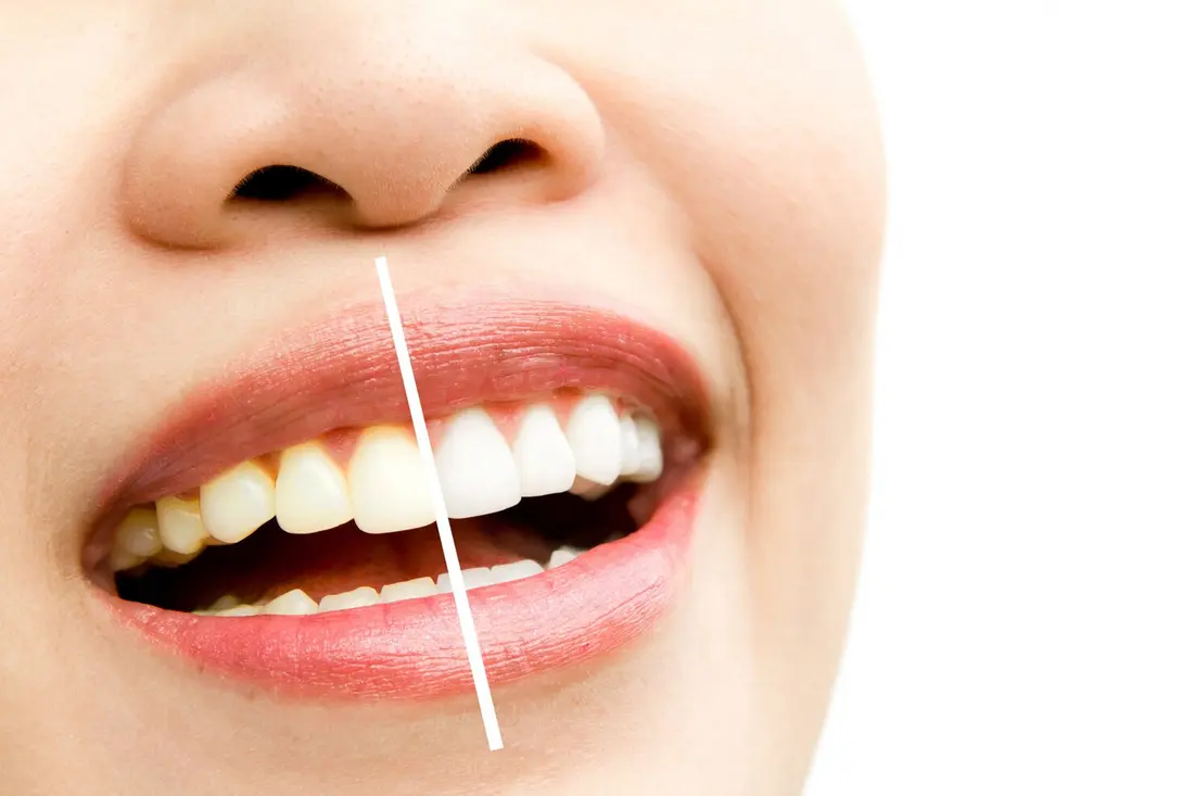 Primer plano de una sonrisa con dientes blancos y alineados